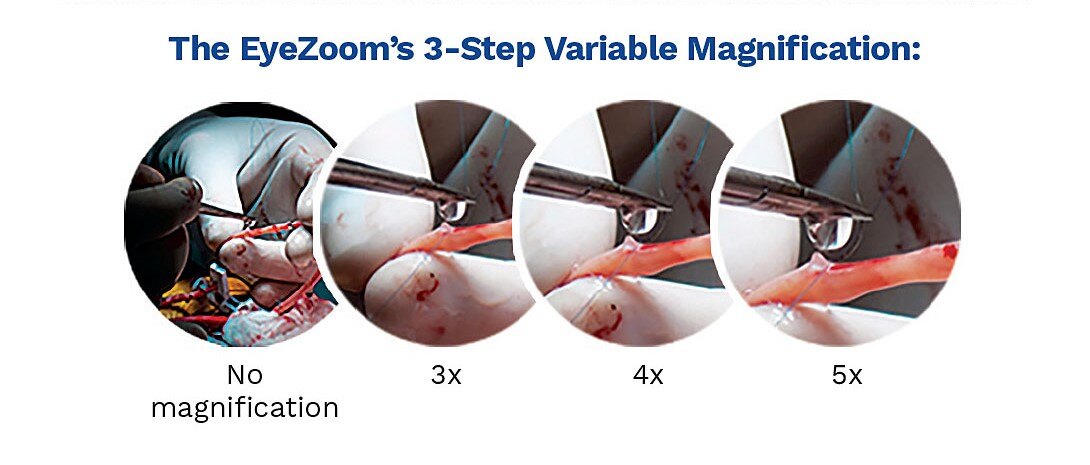 EyeZoom-3steps